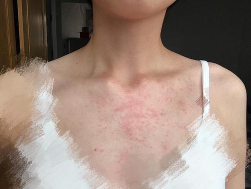 有没有皮肤特别容易过敏的姐妹?