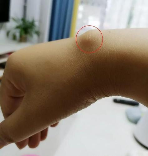 几个月时间,腕痛发展为腱鞘囊肿!医生提醒:这个病女