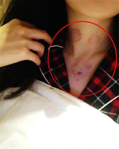 网友发现杨幂脖子上有吻痕, 真实情况让人为她心疼