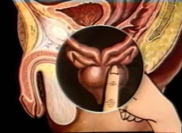 前列腺按摩人人都适用吗