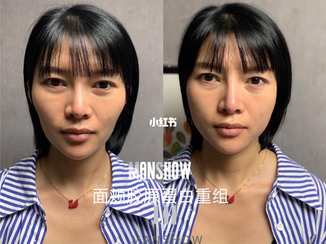 面颊凹陷_微蜜闷秀个体工作室攻略_胶原蛋白_面颊凹陷