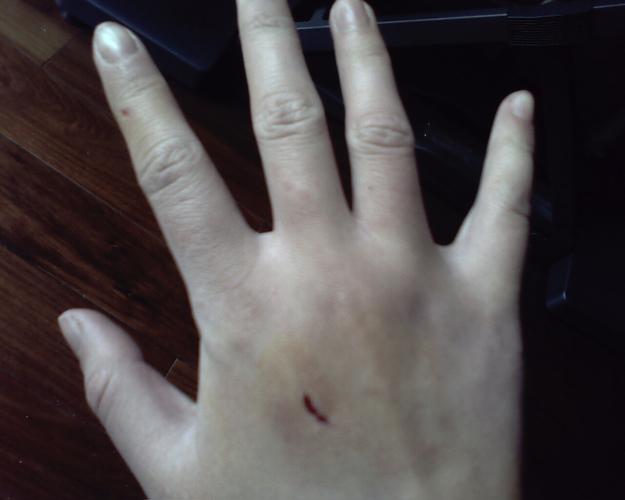 经过今天早上的统计,一共咬了7处见血的伤口.这些只是冰山一角