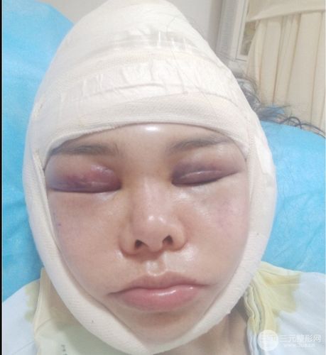 磨颧骨整形手术恢复效果 颧骨整形手术案例图片分享