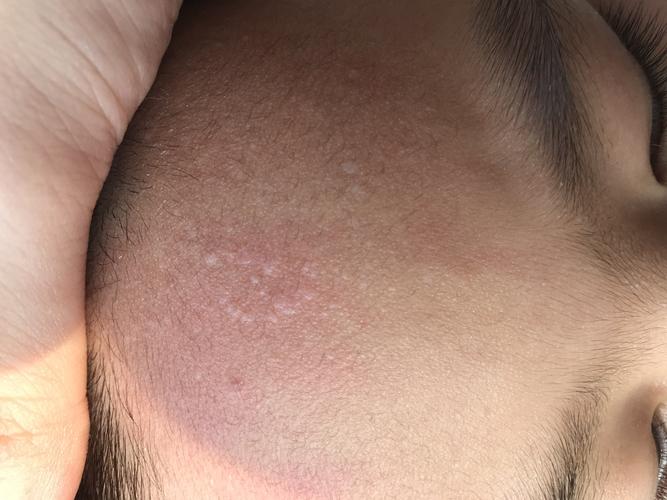 小孩额头上长一个个这样白色的东西,请问有知道是什么