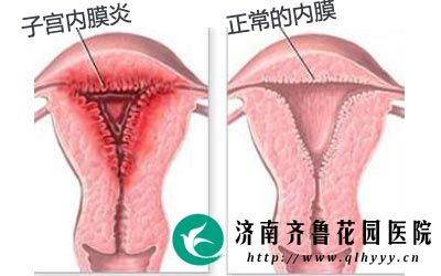 子宫内膜炎有什么症状表现