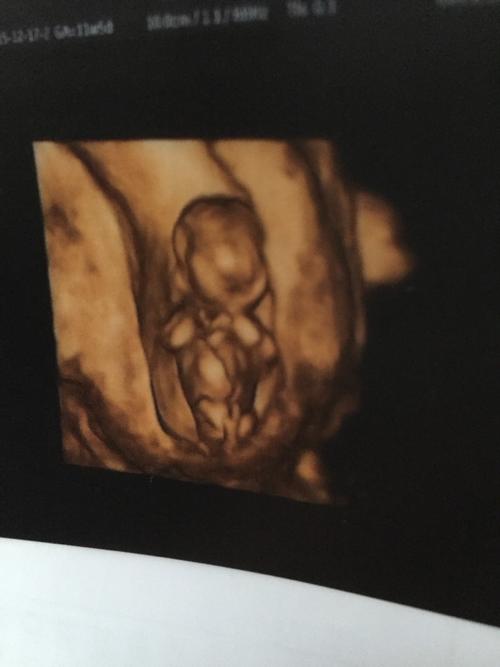 孕11周做了b超,单子上有照片,实在是很好奇是男宝宝还是女宝宝,有没有