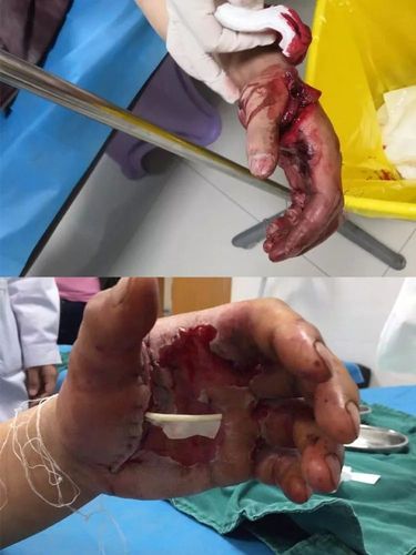 仁怀一老师在救火时点燃灭火弹手掌被严重炸伤