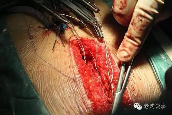 这群外科医生太牛了,幼儿心脏手术大片直播