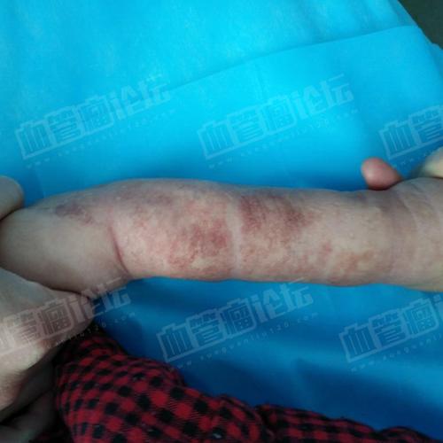 来自赵泽左侧腋下上肢婴幼儿血管瘤患者日记