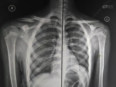 男12岁,锁骨骨折保守还是手术