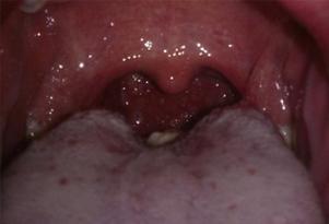 婴儿白喉的症状都是有哪些