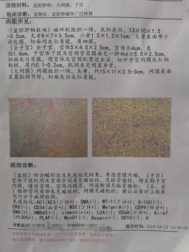 肿瘤,具有间叶和上皮双相分化的特征,约占所有软组织肉瘤的5%～10%,易