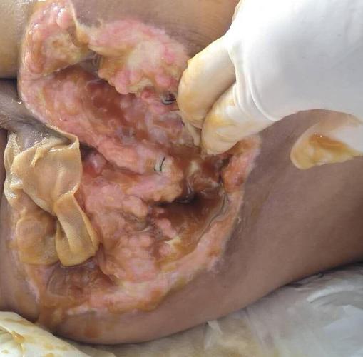 臀部压疮及右下肢感染给予切开引流,每日应用mebt/mebo换药,2次/日,经