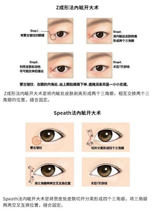 开眼角怎么开