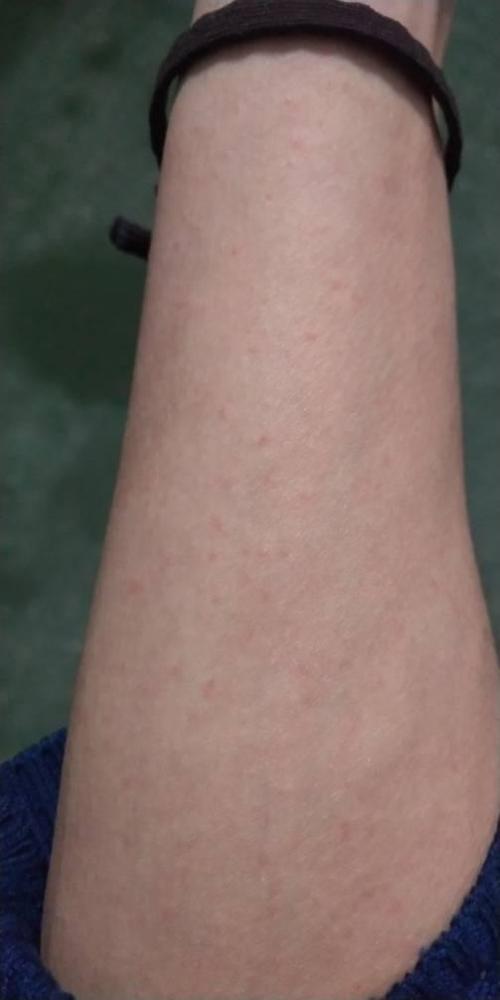 身上起红疹,有时候痒有时候不痒是过敏还是什么病.