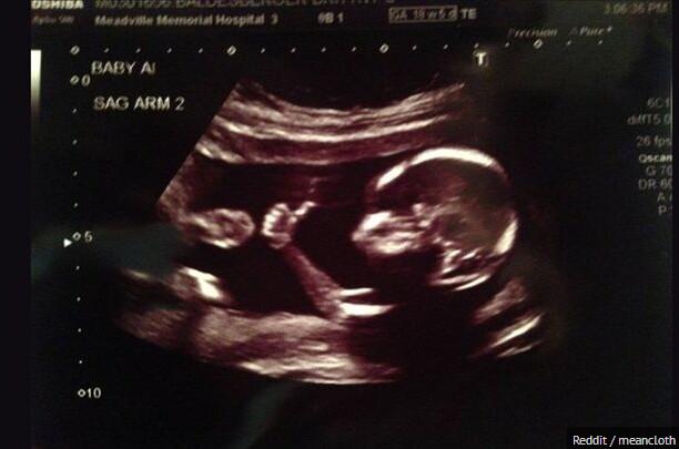 网友晒胎儿竖大拇指b超照片引关注