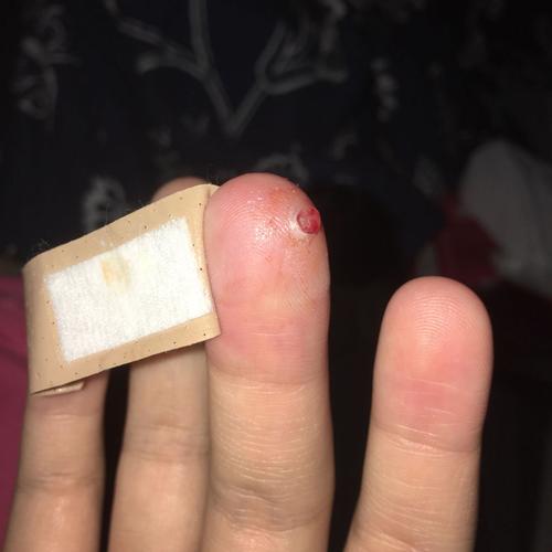 手指长了一个长了一个小肉瘤的东西