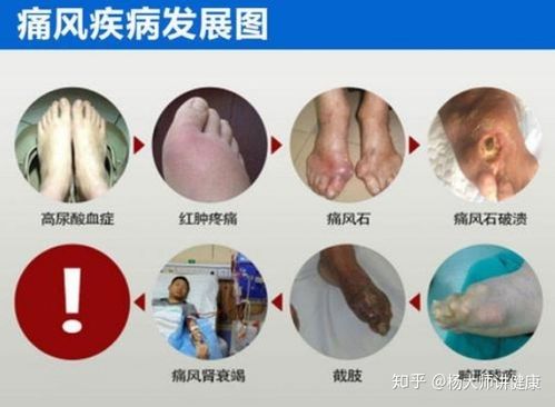 痛风病情的5个级别,快来看看你到第几级啦!