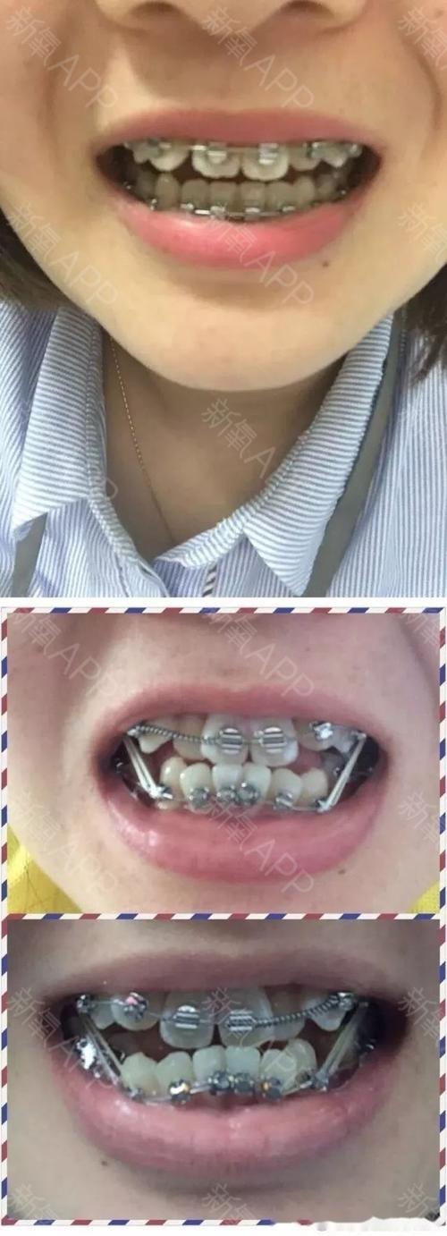 地包天矫正一年了,发个对比图纪念下牙套紧箍咒释法中