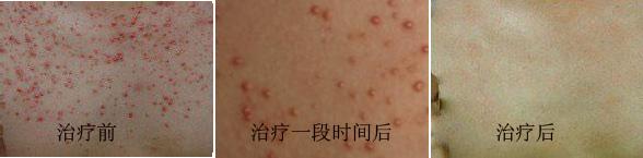 毛囊炎治疗前后对比图
