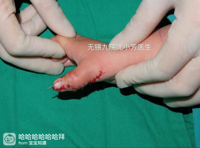 宝宝六指手术后心里的石头终于放下了