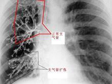 急性气管-支气管炎的并发症