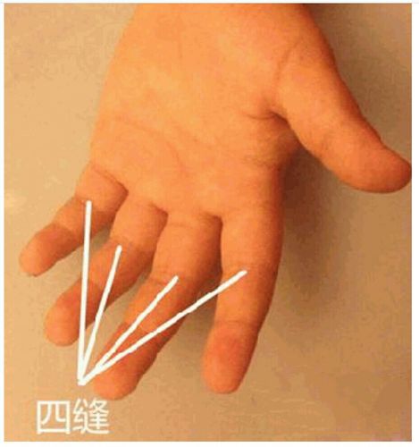 5,掐四缝,用大拇指和食指的指甲掐四缝,每个手指掐10下,也是小儿推拿