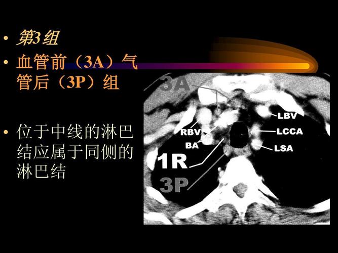 胸部ct纵隔淋巴结分区 (1)
