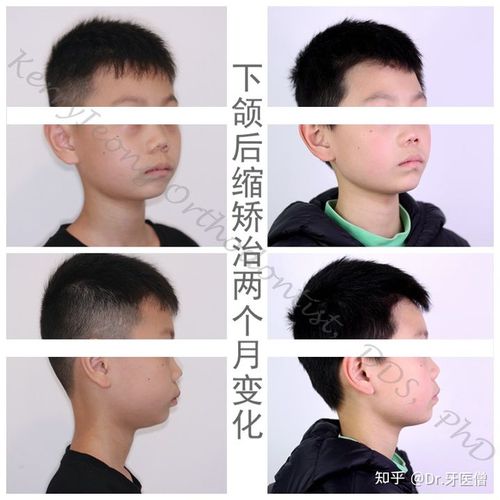 图一是地包天内收下巴后的变化,女性下颌小给人的感觉更加温婉可人.