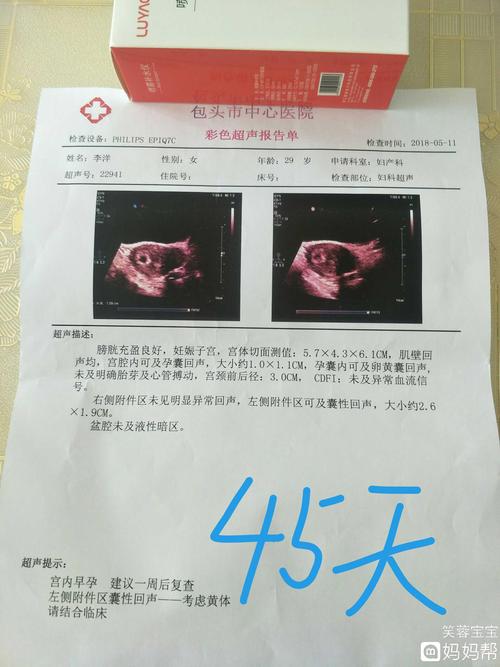 45天和60天分别检查了一次,孕囊形状发生好大的变化,能辨别出男孩女孩