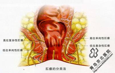 下面是肛瘘的一些常用治疗方法