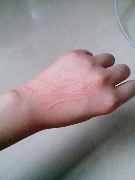 谁能告诉我被兔子挠了用不用打疫苗?