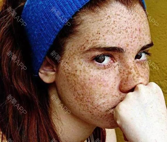 【脸上长雀斑是种什么体验,看完我沉默了.】