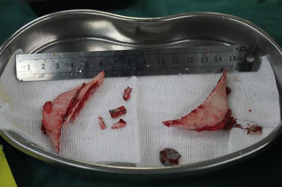 一定要好好享受,从明天开始我就只能喝水啦～可怜    手术当天:   先