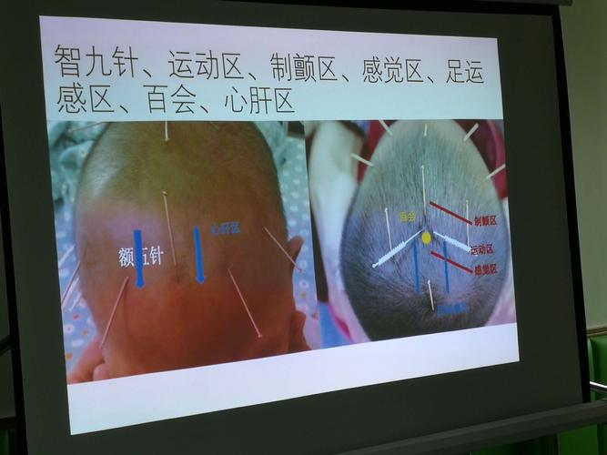 头针电针示意图