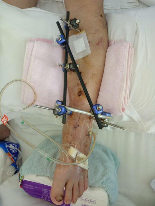 左胫腓骨远端开放性骨折外固定架术后