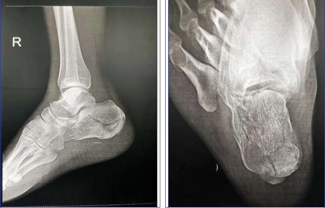 【喜讯】我院成功开展首例跟骨骨折跗骨窦切口微创手术