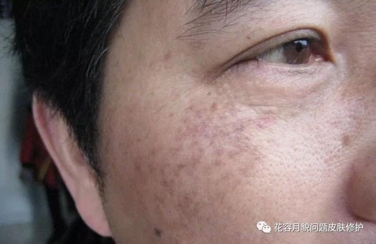 如何鉴别面部常见色斑