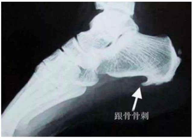 狐大医 | 骨刺是"好东西"!但为啥不招人待见