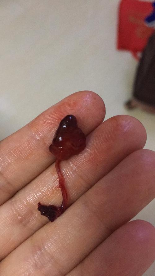 三个多月查处宫颈息肉很大有两个,今天收拾家突然掉出来的!这是