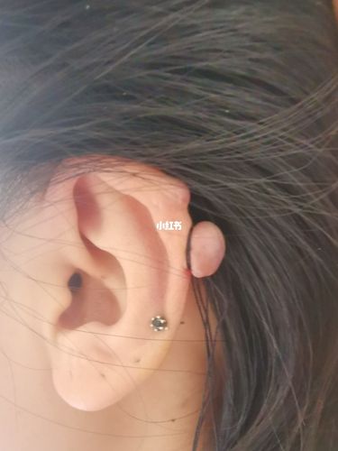 打耳洞出现了这个小疙瘩 长出来了好长时间 最近狠了