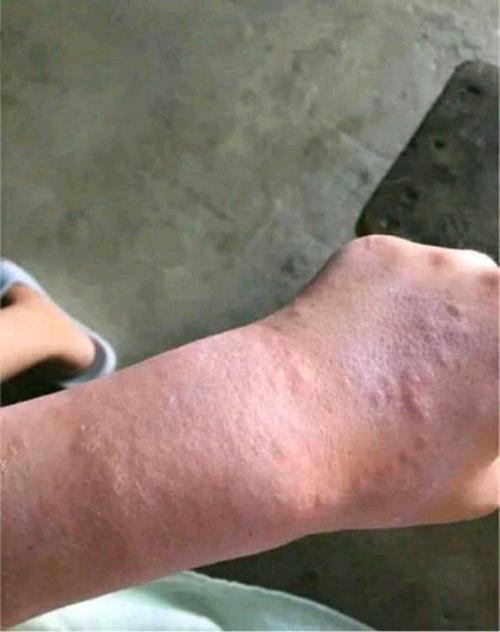 这是被洋辣子蜇伤以后的手臂,严重的时候,被蜇伤的部位会红肿严重.
