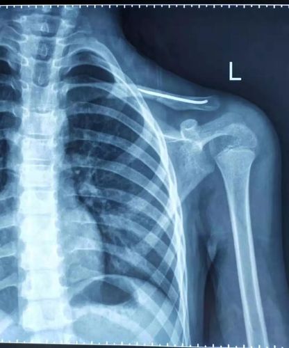 呼市妇幼保健院综合外科完成首例弹性髓内针治疗锁骨骨折患儿