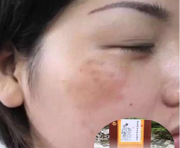 女人脸上为什么容易长斑