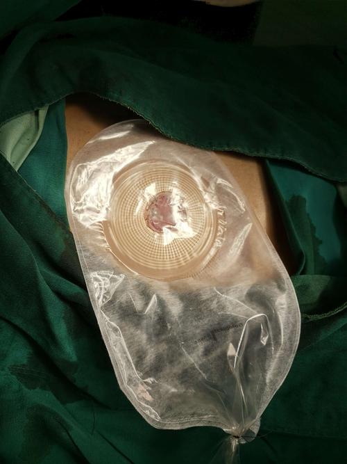 腹部无辅助切口结肠造瘘,创伤小,术后恢复快.