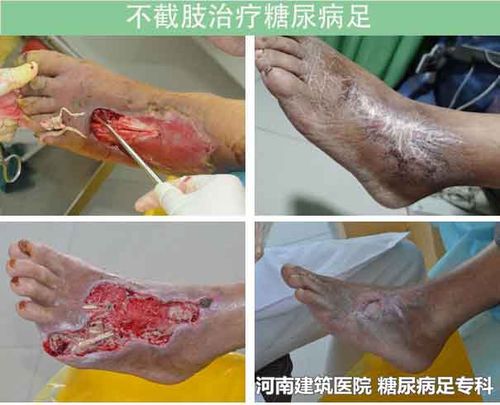 糖尿病人脚烂都化脓了病人还能活多久?