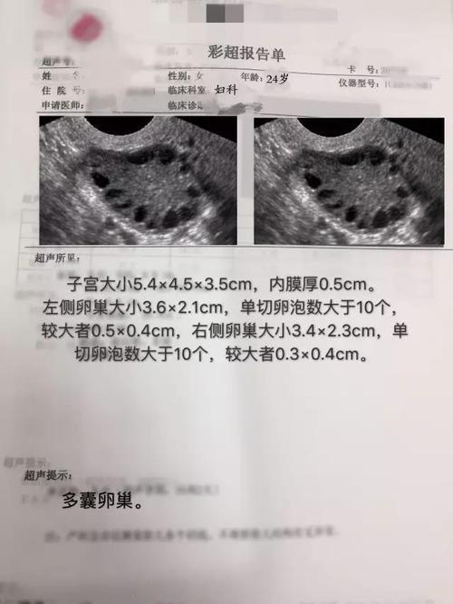 论持久战之多囊卵巢综合征的治疗