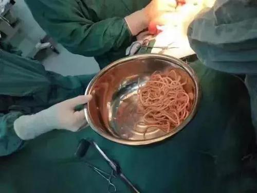 结果如图所示,医生从蔡女士胃里取出了一大盆异尖线虫!