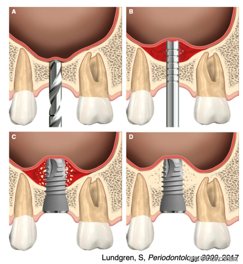 科普系列-什么是上颌窦内提升