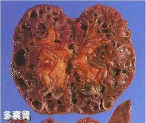 com 肾囊肿发生原因还不十分清楚,一般认为属于肾脏退行性变,因而发病